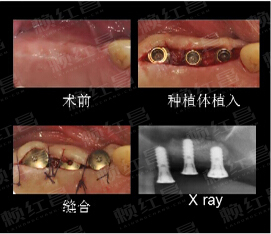 双侧上颌后牙区重度骨量不足口腔种植修复病例