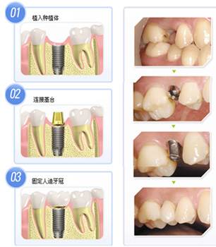 口腔种植牙