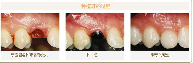 种植牙过程