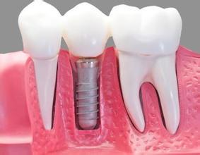 赖红昌教授：先天性牙齿缺失能不能治疗