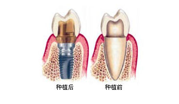 赖红昌教授：假牙正逐渐淘汰，你还不知道种植牙吗？