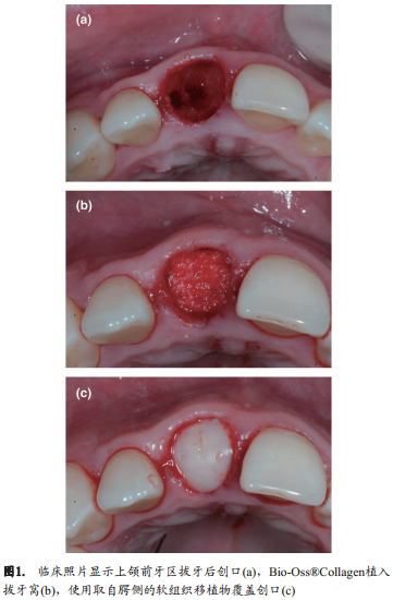 人类新鲜拔牙窝植骨后的牙槽嵴改变