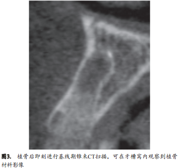 人类新鲜拔牙窝植骨后的牙槽嵴改变