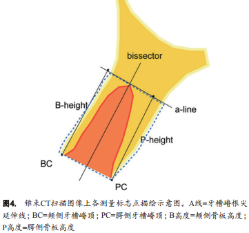 人类新鲜拔牙窝植骨后的牙槽嵴改变