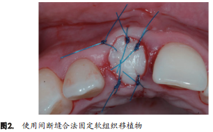 人类新鲜拔牙窝植骨后的牙槽嵴改变