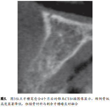 人类新鲜拔牙窝植骨后的牙槽嵴改变