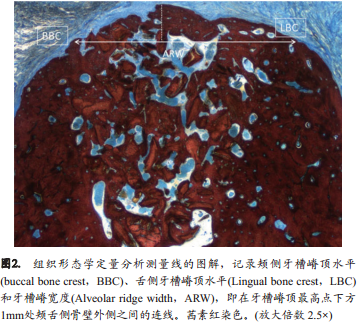 不翻瓣牙槽嵴位点保存术中是否移植异种骨对颊侧骨嵴改建的影响的组织形态学定量分析和显微CT成像研究