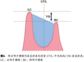 使用Bio-Oss骨胶原或联合使用胶原膜对于慢性感染拔牙窝的牙槽嵴保留效果