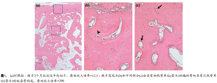 使用Bio-Oss骨胶原或联合使用胶原膜对于慢性感染拔牙窝的牙槽嵴保留效果