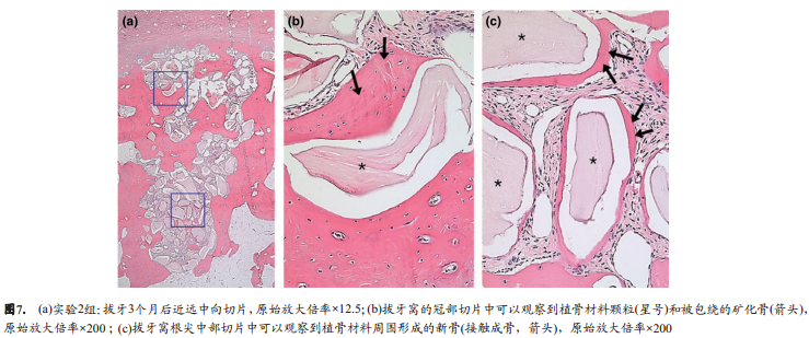 使用Bio-Oss骨胶原或联合使用胶原膜对于慢性感染拔牙窝的牙槽嵴保留效果