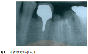 人拔牙后牙槽骨的组织改变:自然愈合与牙槽嵴保存术的比较研究