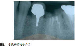 人拔牙后牙槽骨的组织改变：自然愈合与牙槽嵴保存术的比较研究