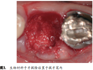人拔牙后牙槽骨的组织改变：自然愈合与牙槽嵴保存术的比较研究
