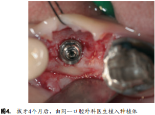 人拔牙后牙槽骨的组织改变：自然愈合与牙槽嵴保存术的比较研究