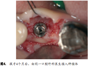 人拔牙后牙槽骨的组织改变:自然愈合与牙槽嵴保存术的比较研究