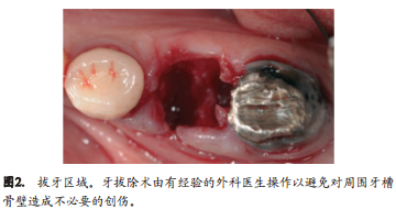 人拔牙后牙槽骨的组织改变:自然愈合与牙槽嵴保存术的比较研究