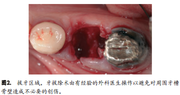 人拔牙后牙槽骨的组织改变：自然愈合与牙槽嵴保存术的比较研究