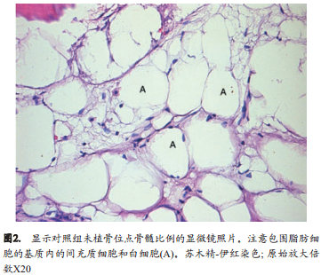 脱蛋白小牛骨应用于牙槽嵴保存技术的研究