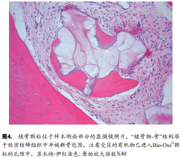 脱蛋白小牛骨应用于牙槽嵴保存技术的研究