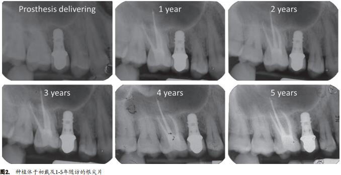 6mm中度粗糙表面短种植体支持单冠的早期负载研究