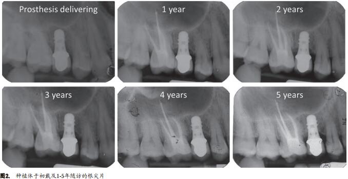 6mm中度粗糙表面短种植体支持单冠的早期负载研究 