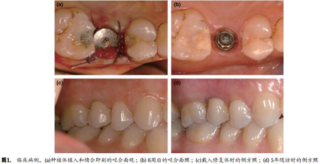 6mm中度粗糙表面短种植体支持单冠的早期负载研究 