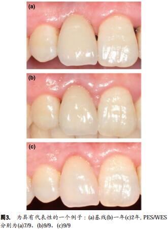 种植体单冠修复的美学效果及软组织改变
