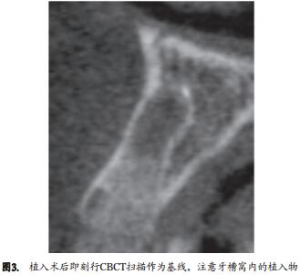 人类新鲜拔牙窝植骨后牙槽嵴改建