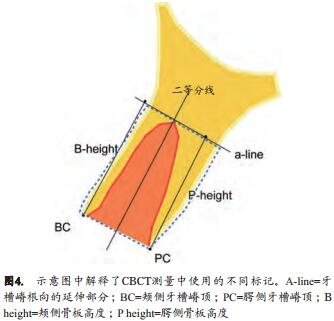 人类新鲜拔牙窝植骨后牙槽嵴改建