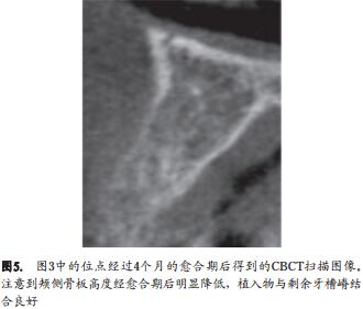 人类新鲜拔牙窝植骨后牙槽嵴改建