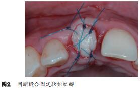 人类新鲜拔牙窝植骨后牙槽嵴改建