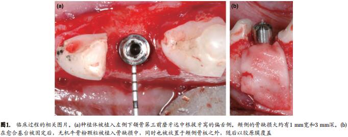即刻种植同期牙槽嵴保存术的数字化分析