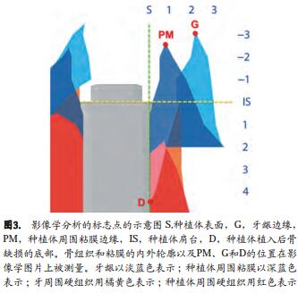 即刻种植同期牙槽嵴保存术的数字化分析