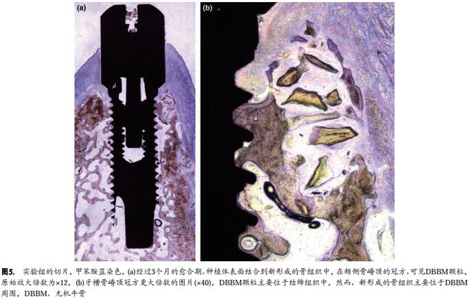 即刻种植同期牙槽嵴保存术的数字化分析