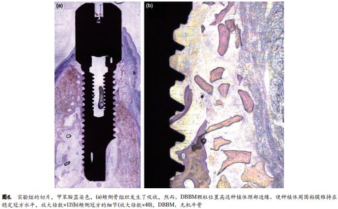 即刻种植同期牙槽嵴保存术的数字化分析