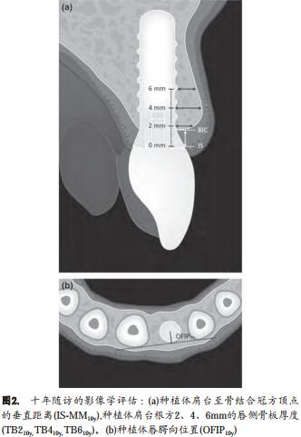 即刻种植同期骨引导再生术在美学区应用10年回顾性研究
