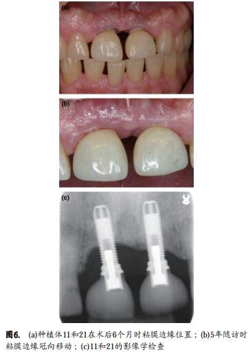 手术治疗种植体周围炎后牙周支持治疗的作用