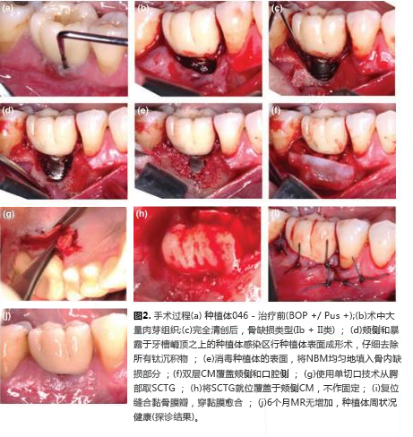 牙齿种植,种植体周围炎