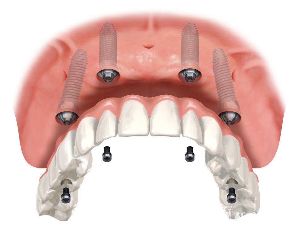 ALL-ON-4种植牙