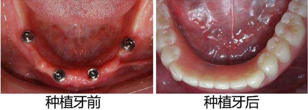 下半口种植牙