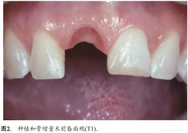 软硬组织增量后种植体周围组织的体积增量及稳定性