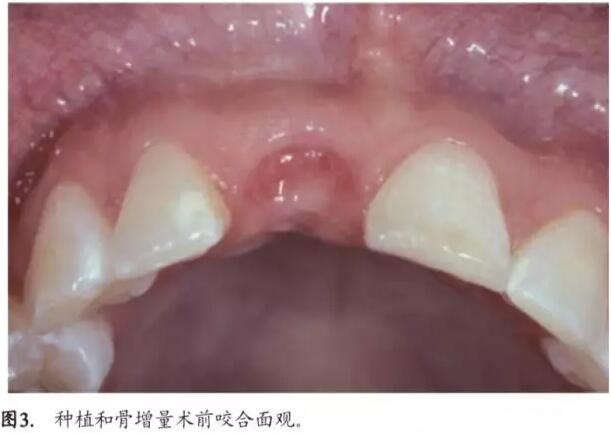 软硬组织增量后种植体周围组织的体积增量及稳定性