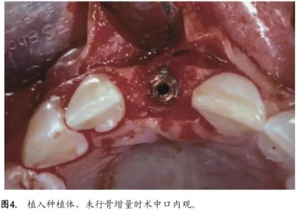 软硬组织增量后种植体周围组织的体积增量及稳定性