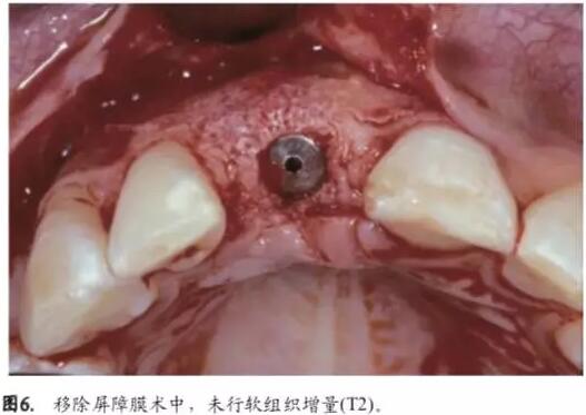 软硬组织增量后种植体周围组织的体积增量及稳定性