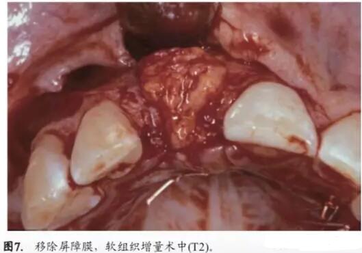 软硬组织增量后种植体周围组织的体积增量及稳定性