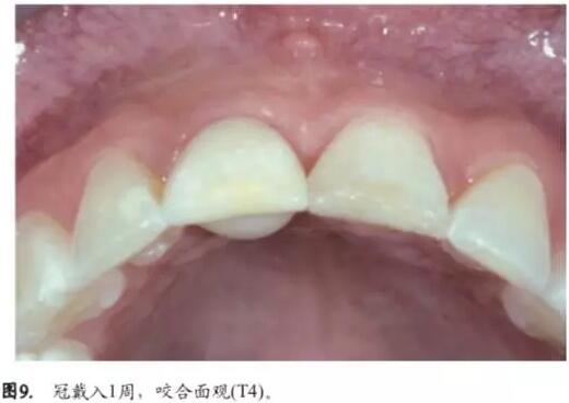 软硬组织增量后种植体周围组织的体积增量及稳定性