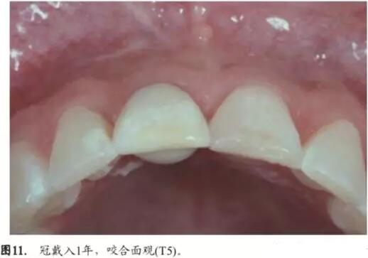 软硬组织增量后种植体周围组织的体积增量及稳定性