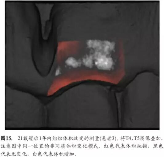 软硬组织增量后种植体周围组织的体积增量及稳定性