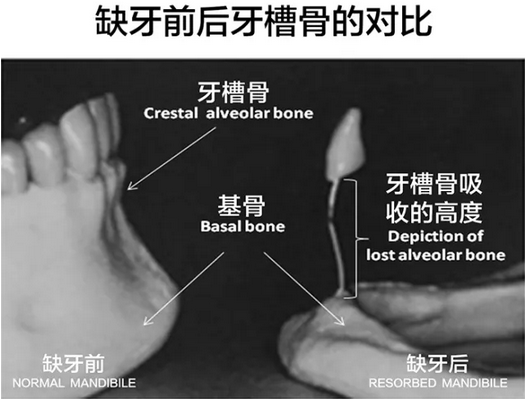 缺牙前后牙槽骨对比图