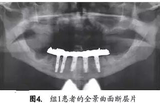 口腔种植